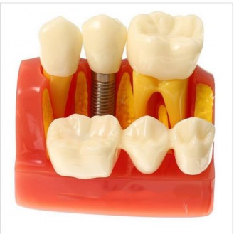 Hàm tư vấn implant và cầu răng - Cái